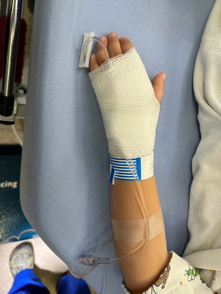 EMLA application, IV placement in the operating room and gauze hand wrap for IV security.