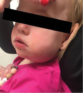 Initial clinical presentation - Lateral view, demonstrating  swelling extending to the angle of the mandible. No apparent bruising or signs of trauma present. 