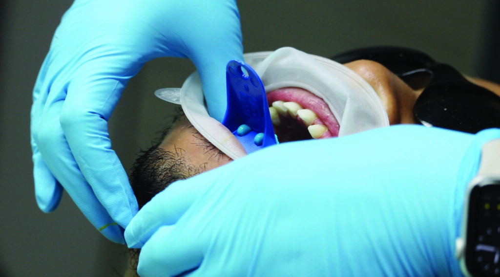 Curing of the analog cast in the mandible.