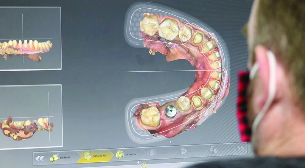 Design of crowns and veneers in inLab. 