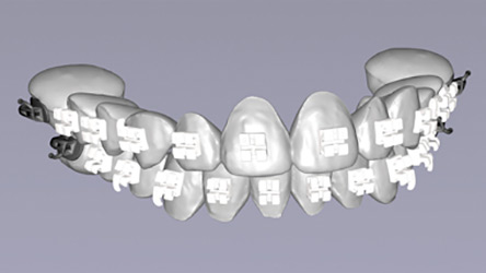 3D-Printed Brackets