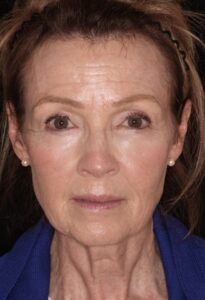 . Patient C: Static lines present on forehead, between the brows and around the eyes before treatment.