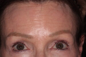 Patient C: 2 weeks after treatment activation of frontalis no longer produces the horizontal lines. 