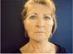 Patient F: Before treatment of DAO showing downward curve of the mouth.  