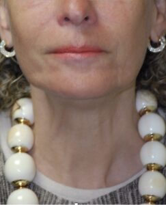 Patient H: After treatment of platysma there is marked smoothing of the neck of the same individual even when platysma is activated.
