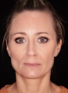 Patient I: 2 weeks after iniection of masseters showing the reduction in size of the enlarged muscles. Grinding and the resulting pain was eliminated. 