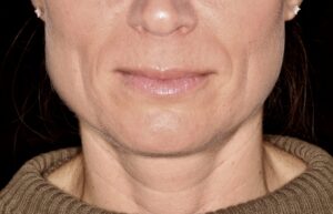 Patient I: Close-up of the lower face before treatment showing the enlarged masseters bilaterally.  
