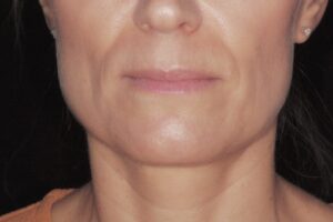  Patient I: Close-up of the face 2 weeks after treatment of masseters showing the reduction in size of the bulkv muscles. 