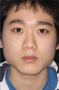  Patient J: Before treatment of hvpertrophic masseters associated with severe bruxism
