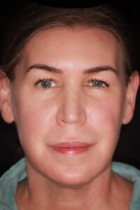 Patient A: 2021 after 13 years of regular treatment of upper face, skin is still smooth and without deep lines or wrinkles. 