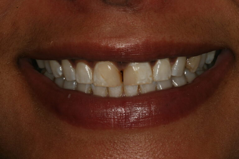 Preoperative full smile.
