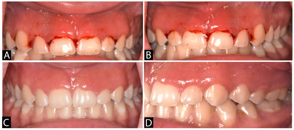 A diffuse erythematous velvety gingival enlargement in the maxillary anterior region spanning entire width of the keratinized gingiva from maxillary left first premolar to maxillary right first premolar. The gingiva showed pale pink, soft, edematous with a granular surface generalized loss of stippling and scalloping. The probing depth on teeth #11, 21, 22 was 5mm with concomitant bleeding on probing and increased mobility.