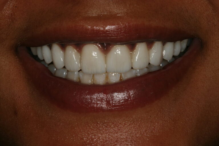Postoperative full smile.