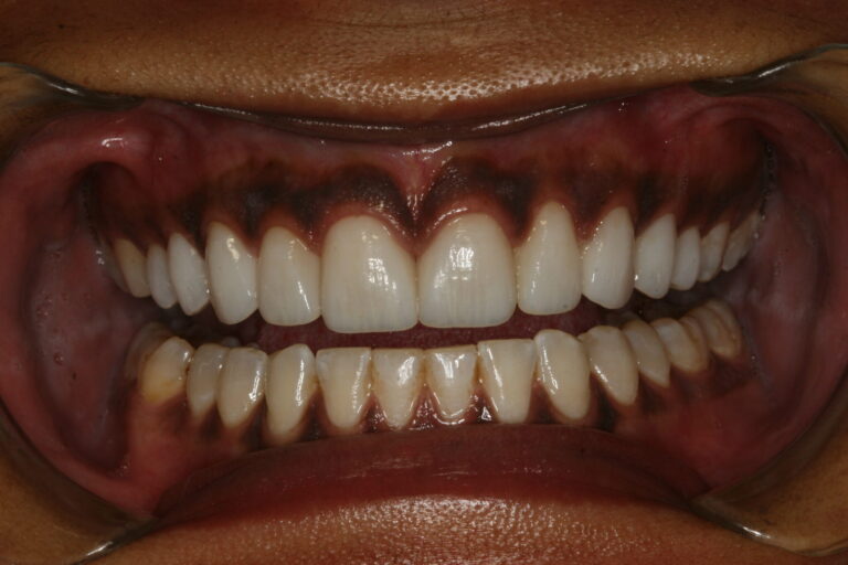 Postoperative retracted view.