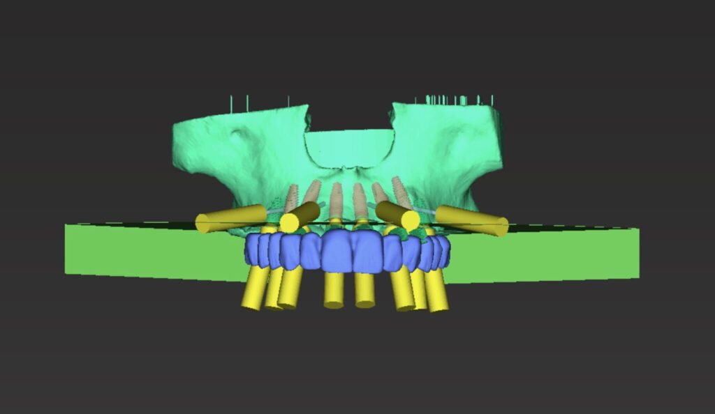  Maxillary surgical treatment planning with maxillary prosthesis using coDiagnostix (Dental Wings software).