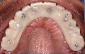 Occlusal view of maxillary PMMA Flexcera Smile (Desktop Health) prosthesis.
