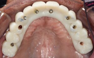  Occlusal view of full maxillary arch try-in PMMA duplicate of final prosthesis.