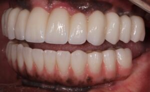 Left lateral view of completed case.  