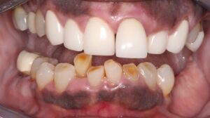 Frontal view showing multiple aesthetic and functional deficits
