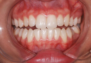 Front close up view, teeth apart and cheeks retracted (after). 