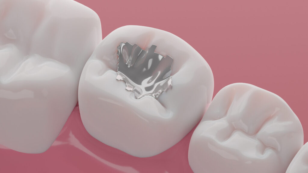 Dental Amalgam