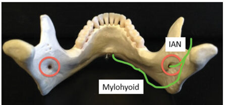 Mylohyoid nerve.14