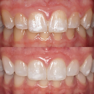 Maxillary canine to canine view. A. prior to vital tooth bleaching. B. post-bleaching