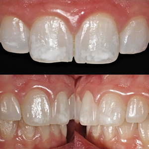 Upper incisors prior to resin infiltration treatment. Notice the increased contrast between white spot lesions and sound enamel after vital tooth bleaching. A. anterior view; B. right lateral view; C. left lateral view