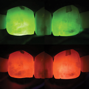 Transillumination using different light filters to visualize lesion depth and extension (after rubber dam application and tight floss ligation). The darker areas suggest deeper lesions. Top: transillumination of upper right and left centrals (orange filter); Bottom: transillumination of upper right and left centrals (green filter). Notice the consistent presentation between the different light filters. Transillumination suggest slightly deeper lesion on the left central.