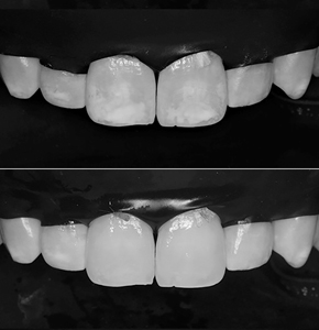 Maxillary canine to canine view under rubber dam isolation. A. Before resin infiltration treatment; B. immediately after resin infiltration treatment