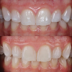 . Canine to canine view after resin infiltration treatment. A. one-week follow up; B. 14 month follow up. Note the color stability after 14 months.
