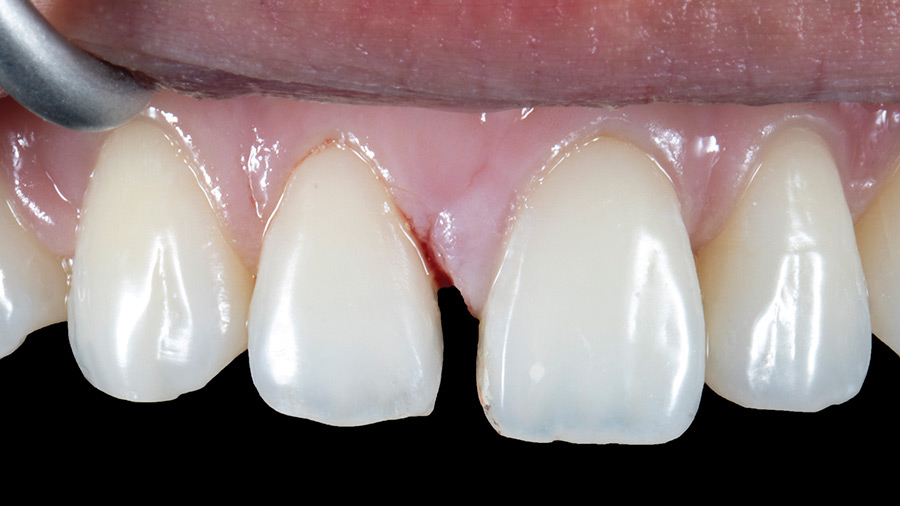 single tooth