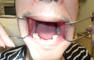 Pre-injection photo (frontal view) with cheeks retracted to show generous amount of saliva on buccal mucosa.
