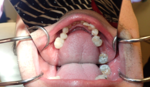 Pre-injection photo (mandibular view) to show generous amount of saliva on floor of mouth and buccal mucosa.