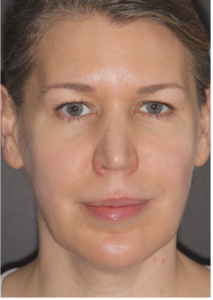  Patient A: 2015 after regular treatment of upper face.  