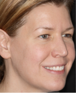  Patient A: 2015 after regular treatment of upper face.